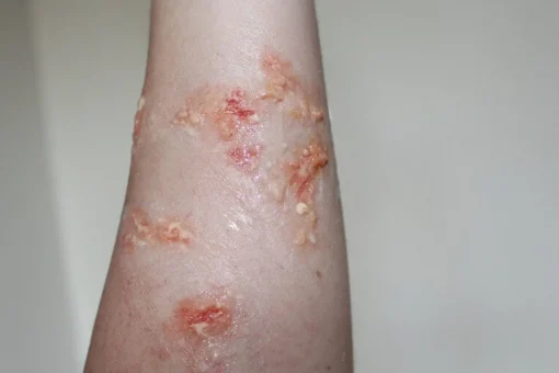 ForensicFX Studios Infected Blisters / Boils Prosthetic Cheap