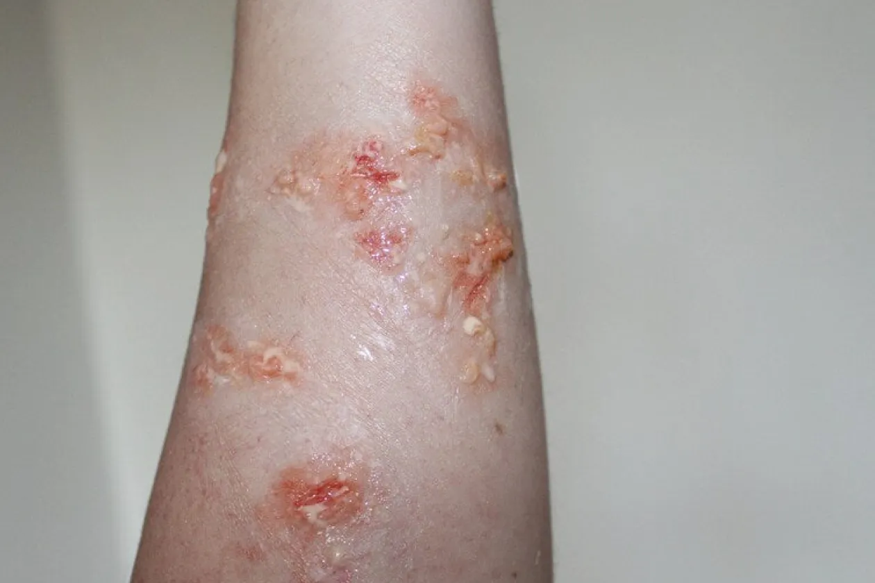 ForensicFX Studios Infected Blisters / Boils Prosthetic Cheap