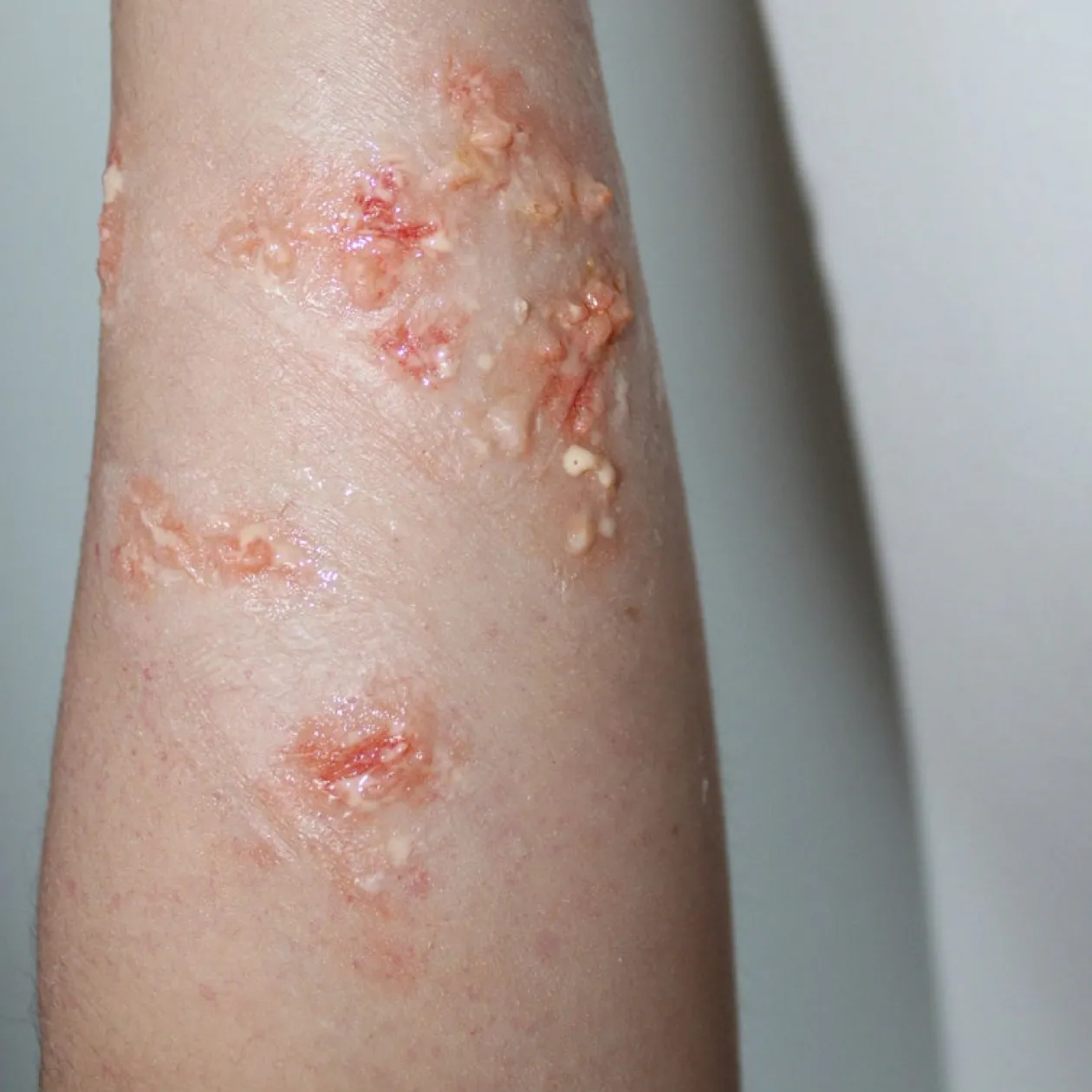 ForensicFX Studios Infected Blisters / Boils Prosthetic Cheap