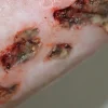 ForensicFX Studios Infected Wound / Burn Prosthetic Sale