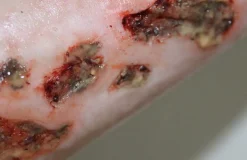 ForensicFX Studios Infected Wound / Burn Prosthetic Sale