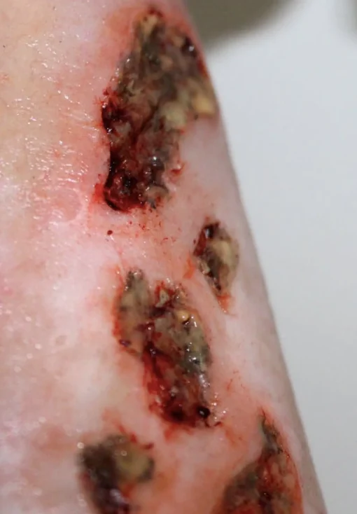 ForensicFX Studios Infected Wound / Burn Prosthetic Sale