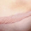 ForensicFX Studios Large Healed Keloid Scar Flash Sale